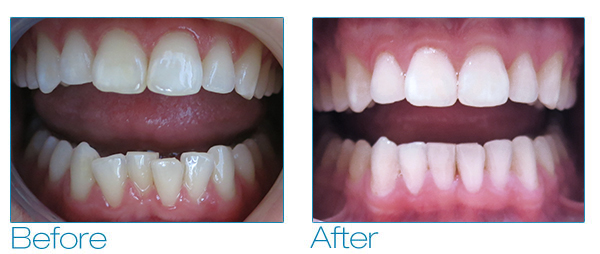 Invisalign Invisible Braces  Free Teeth Whitening Included